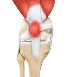 Bursitis