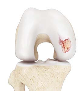 Chondral (Articular Cartilage Defects)